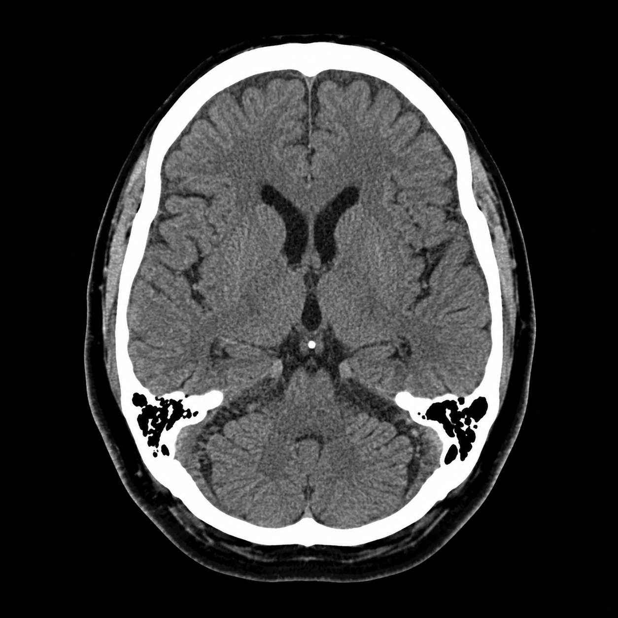 Neuro CT